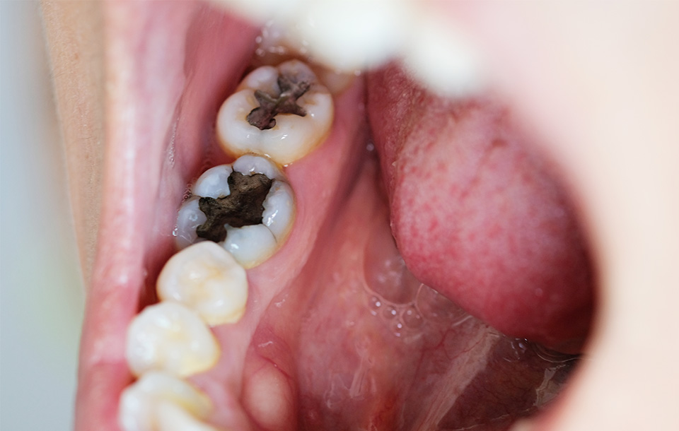 STEP1:歯科衛生士による口腔内チェック